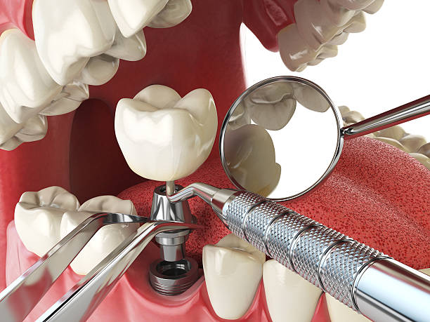 Best Emergency Wisdom Teeth Removal in Sheridan, CA